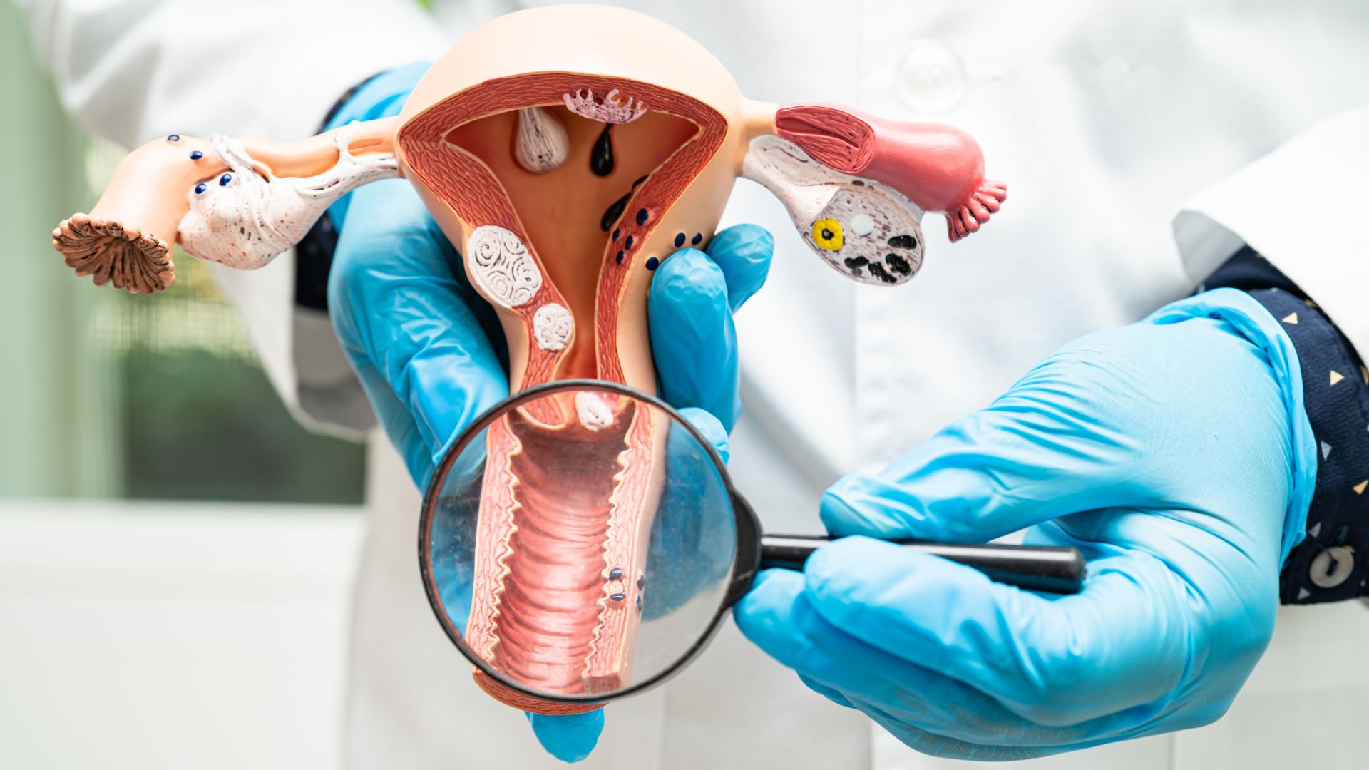 ¿Cómo podemos prevenir el cáncer de cuello uterino (cáncer de cérvix)?