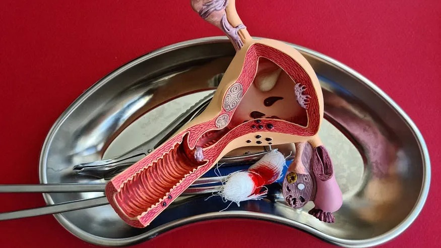 ¿Qué es la Histerectomía Total Abdominal?